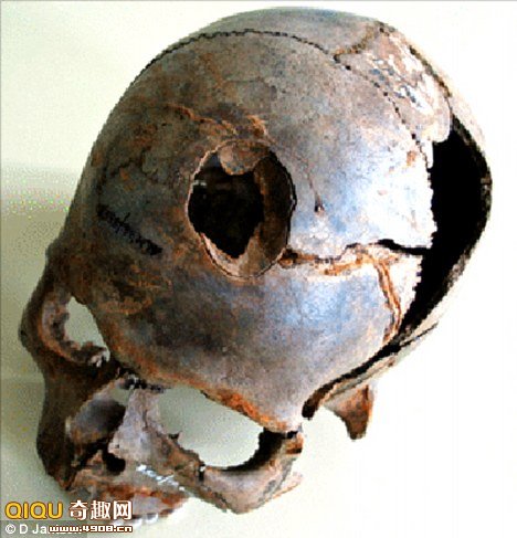 [图文]德国发现了一些骨折的头骨和破碎的骨头遗骸